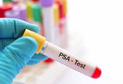Testen op prostaatkanker Testen op prostaatkanker